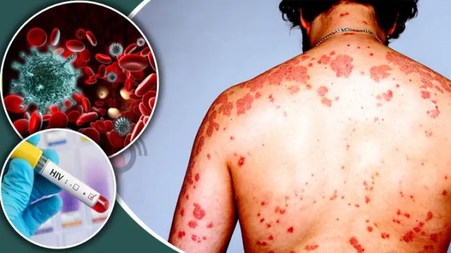 HIV Infections Surge in Rajshahi: 28 New Cases Reported in 10 Months