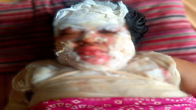 UP Member's Wife Seriously Burned in Alleged Attack and Vandalism in Jhalakathi