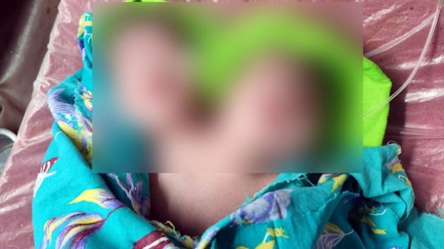 A newborn baby with two faces lies under intensive care at Rajshahi Medical College Hospital after being born with a rare congenital condition known as craniofacial duplication, in Tanore, Rajshahi on Saturday night.